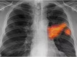 油烟污染与肺结节形成的潜在关联探究